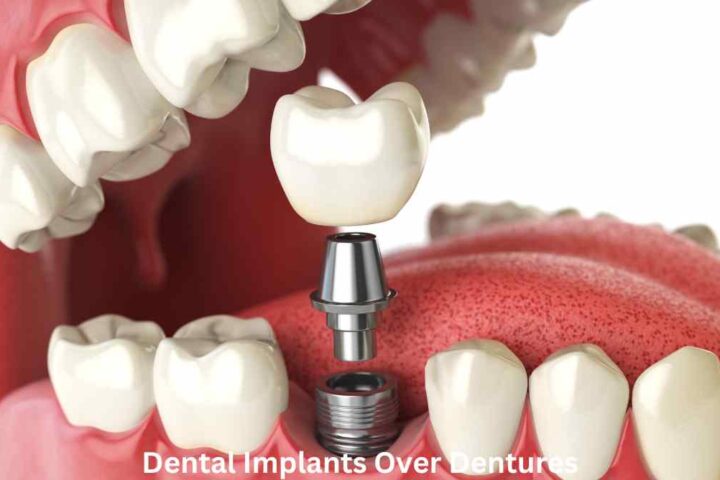 Dental Implants Over Dentures