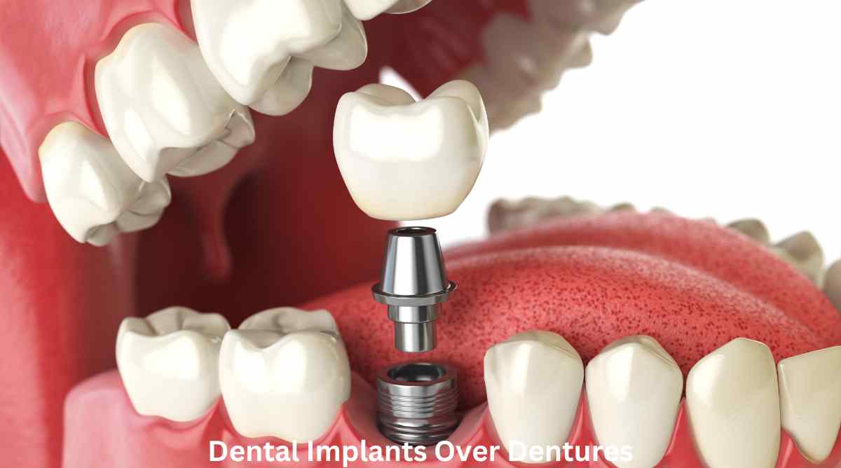 Dental Implants Over Dentures